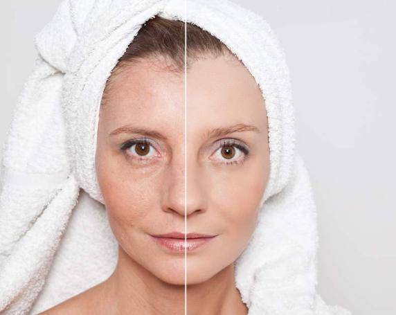 How Does RF Radio Frequency Skin Tightening Work?